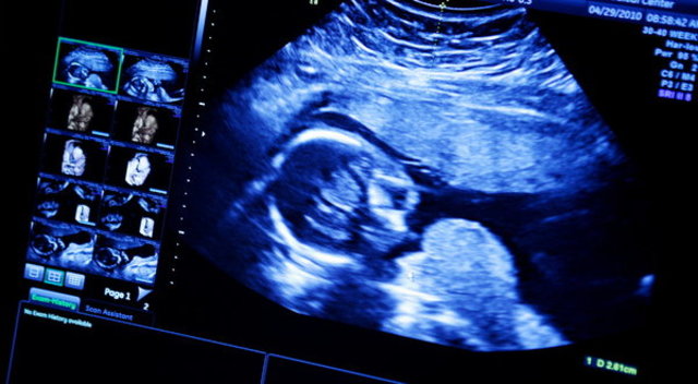 Fetal Ultrasound