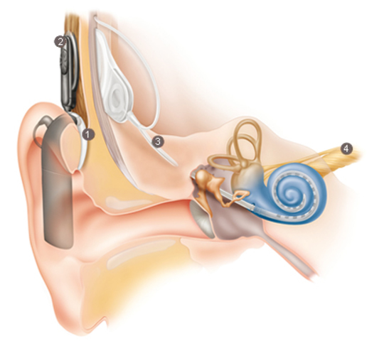 Cochlear Implant