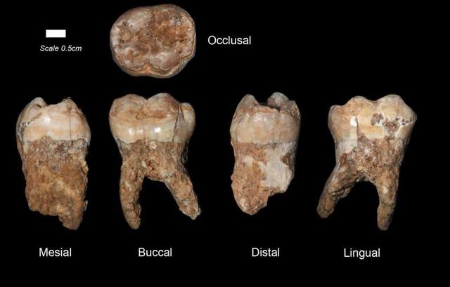 Tooth decay is noted