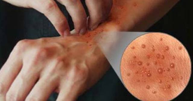 Se descubrió la intoxicación paralítica por el consumo de marisco.