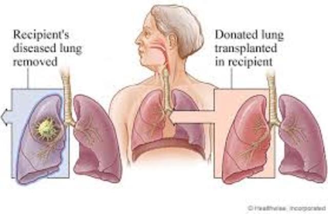 First Lung Transplant