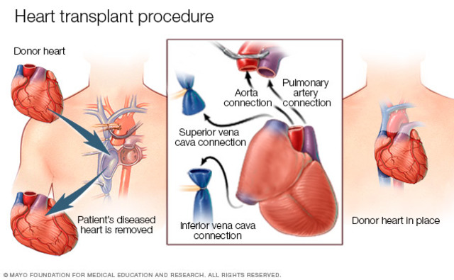 First human heart transplant