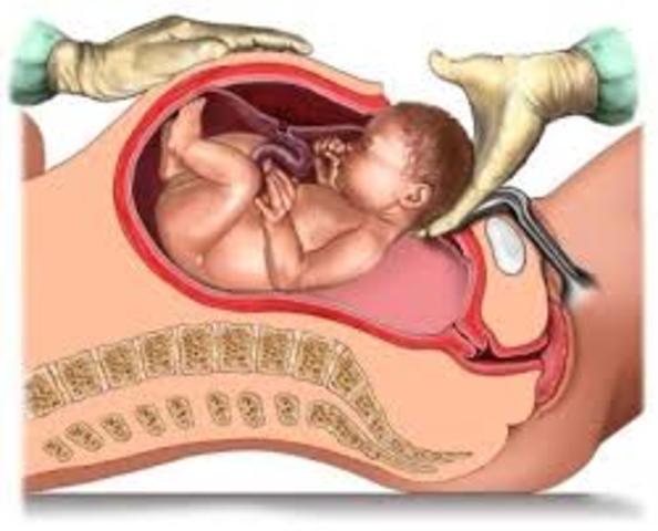 Cesarean Section  (C-Section)