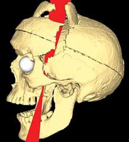 Phineas Gage suffers brain damage