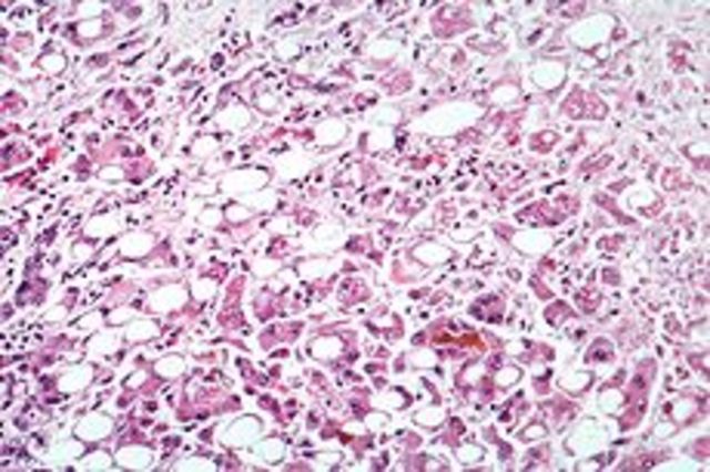 Hepatisis in Gujarat, 2009