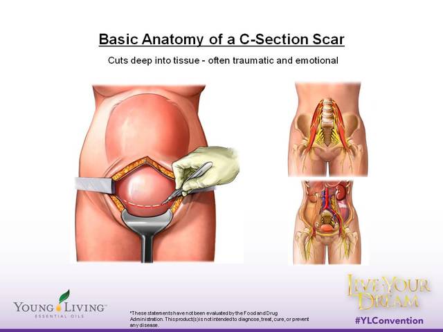 C-Sections