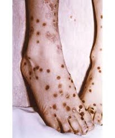 Discovery of the differences between small pox and measles