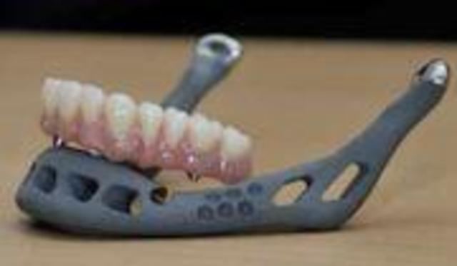 PRIMER IMPLANTE DE PRÓTESIS DE MANDÍBULA IMPRESA EN 3D