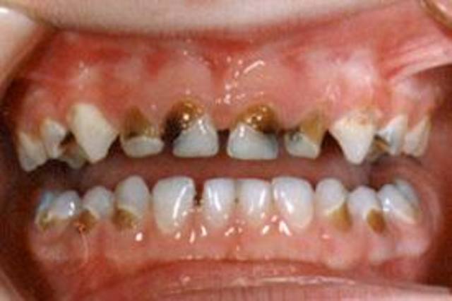 LECHE MATERNA COMO FACTOR DE RIESGO EN CARIES