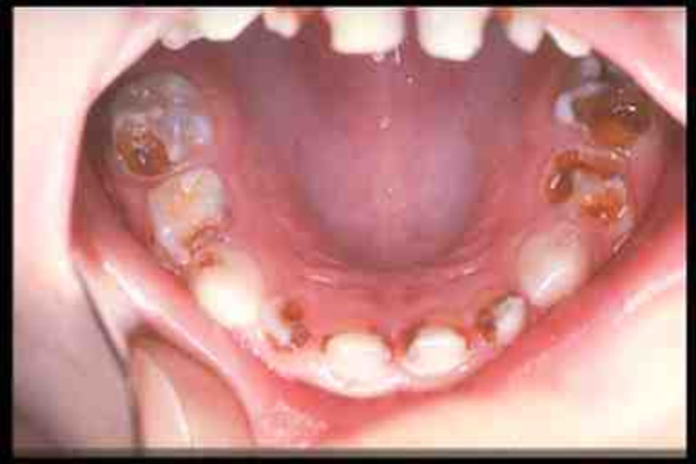 CARIES TEMPRANA EN INFANCIA