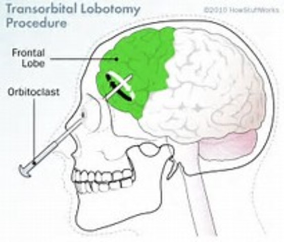 First lobotomy in the United States