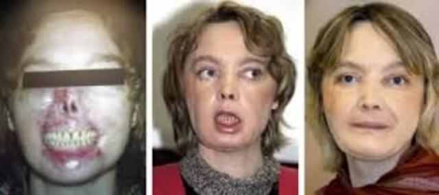 Jean-Michel Dubernard performed the first partial face transplant.