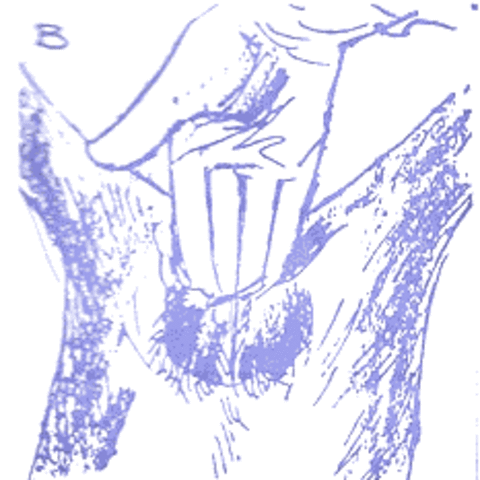 Invención de la castración