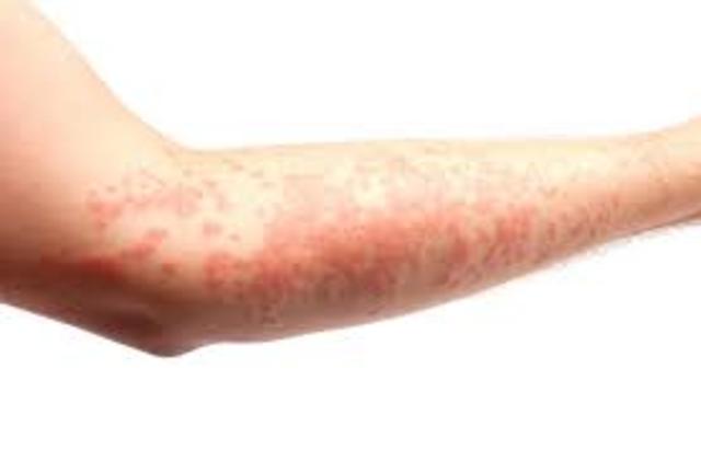 Large Amounts of Histamines are Released Causing an Allergic Reaction