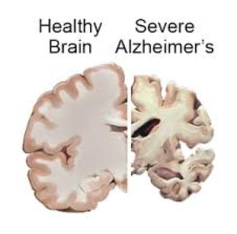 first case of Alzheimer disease