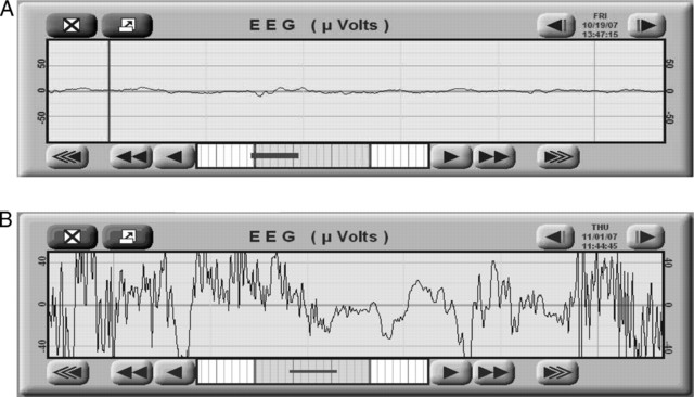 ELECTROENCEFALÓGRAFO COMERCIAL
