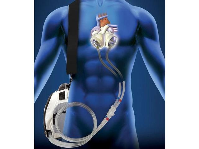 Implanted first artificial heart