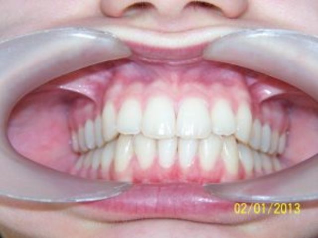 Se demosotro la importancia de la rehabilitacion oclusal