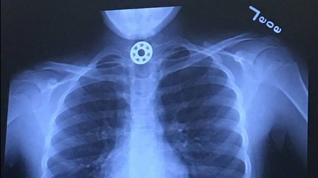 the negative effect of fidget spinners