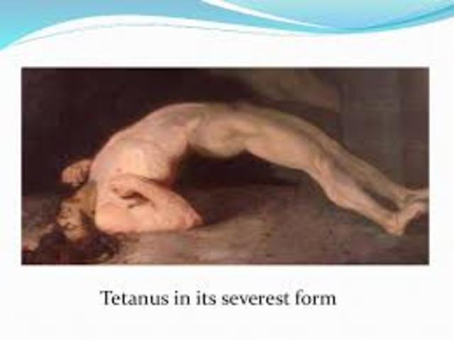First vaccine developed for tetanus.