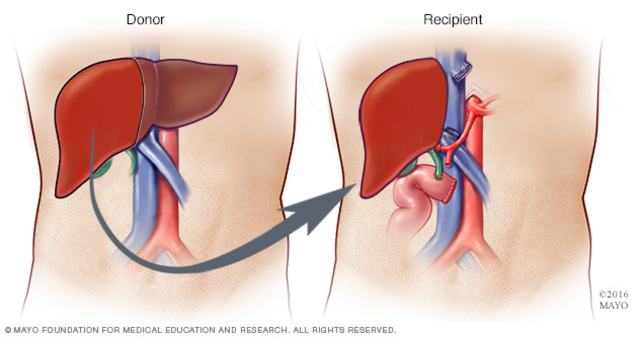 Liver Transplant