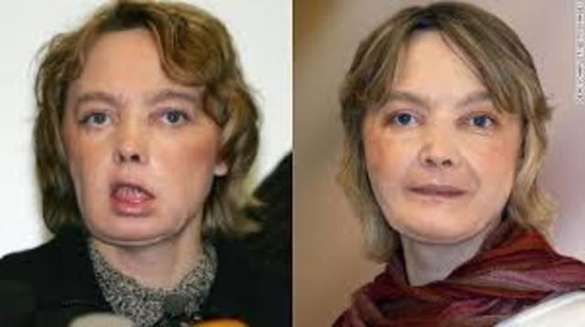 Face Transplants