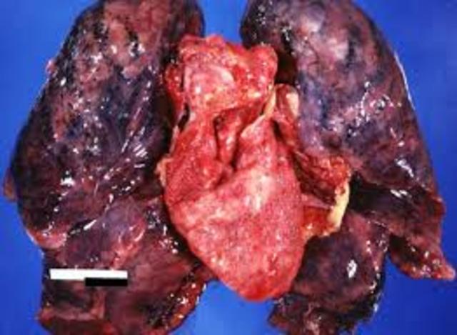 Study Finds Heart, Cancer Risk with Hormone Replacement Therapy