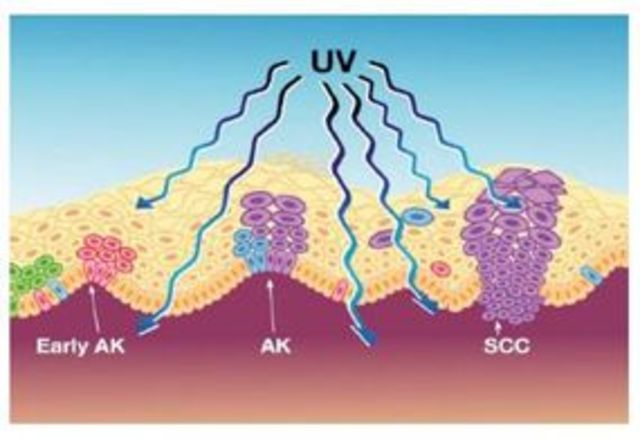 Nascita di grosse molecole, danneggiate dai raggi uv