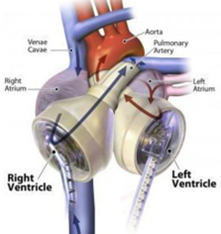 FDA approves firs artificial heart place in a patient