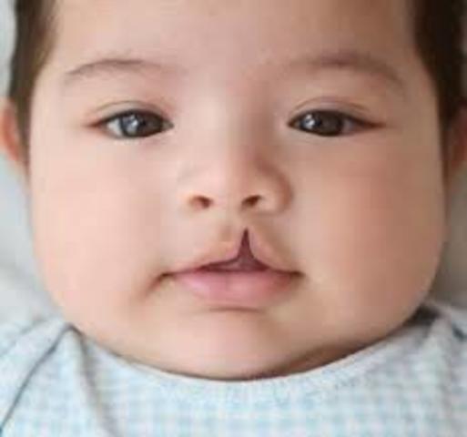 Cleft Lip (Birth Defect #1)