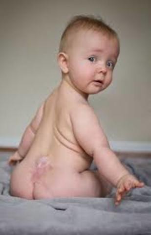 Spina Bifida (Birth Defect #2)