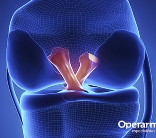 Me rompí el ligamento cruzado anterior