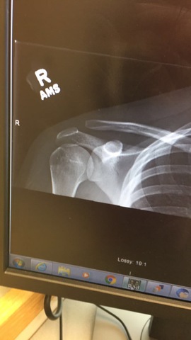 Broke my collarbone