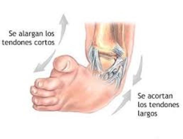 Me operaron ya que tenia el pie equino varo