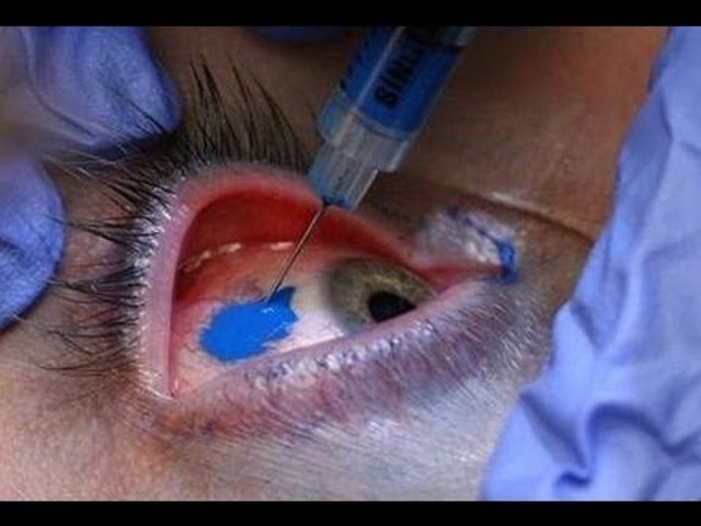 Tatuaje en el ojo