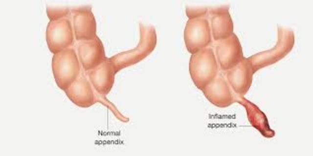 When I got Appendicitis