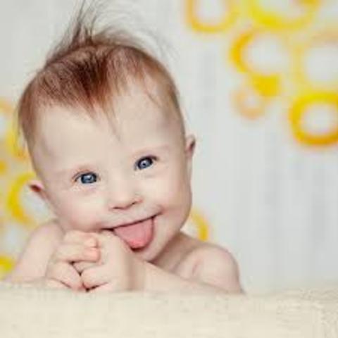 Down Syndrome (Birth Defect #5)