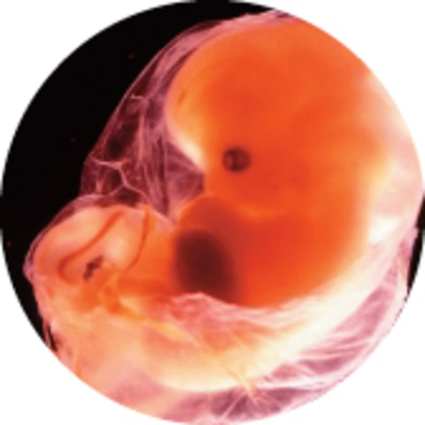 Pregnancy at 2 months.