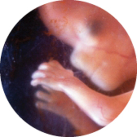 Pregnancy at three months or 13 weeks.