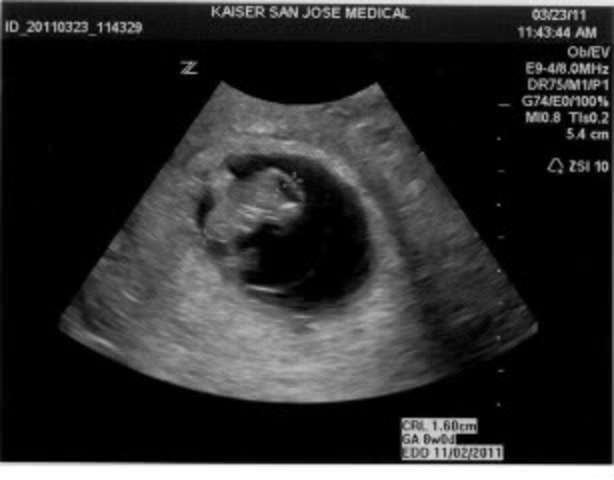 Pregnancy at 7 & 8 weeks