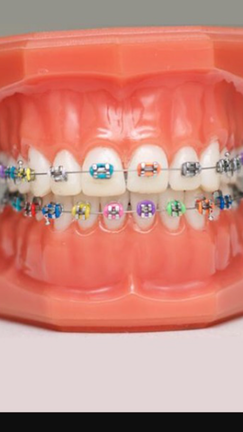 Getting my braces taken off