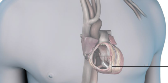 Leadless Pacemakers