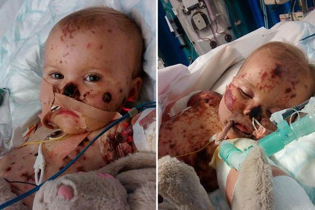 Koch discovered the microbe that caused septicaemia