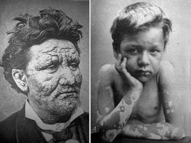 Hansen-Discovered the microbe that caused leprosy