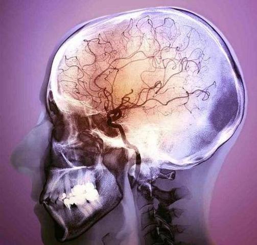 Spallazani suffered a stroke