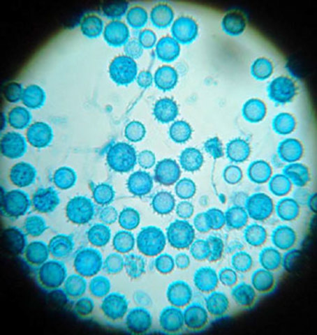 Histoplasmosis