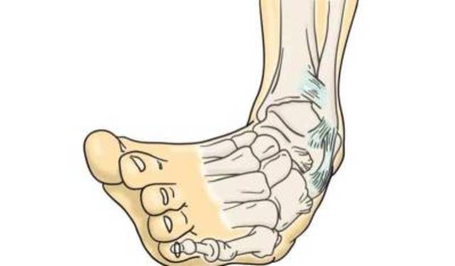 Esguince (casi fractura)