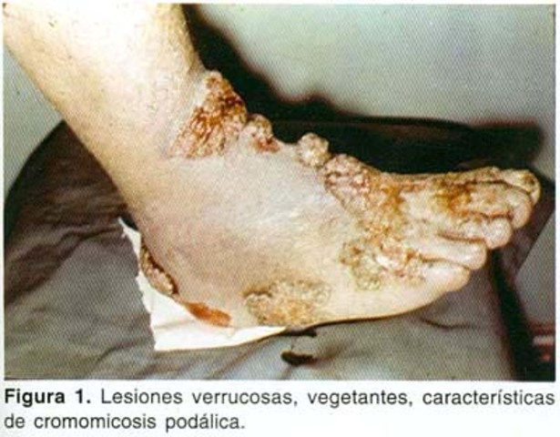 Max Rudolph, Cromomicosis