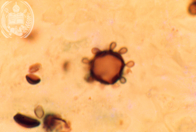 Adolfo Lutz ,Paracoccidioidomicosis