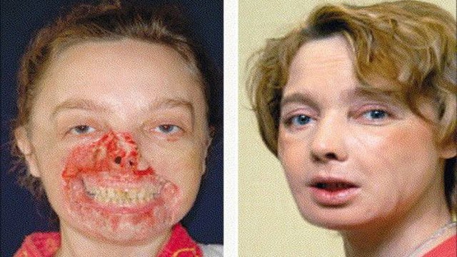 First Partial and Full Face Transplants